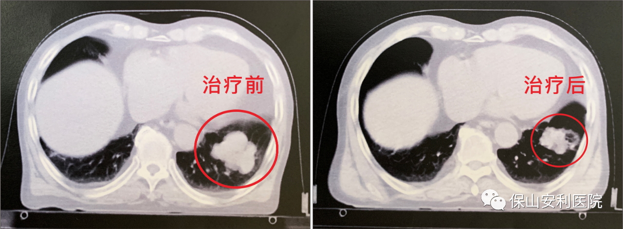 不做手術(shù)，早期肺癌也能根治！