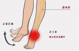 【保山安利醫(yī)院—健康科普】什么是足下垂！你了解嗎？